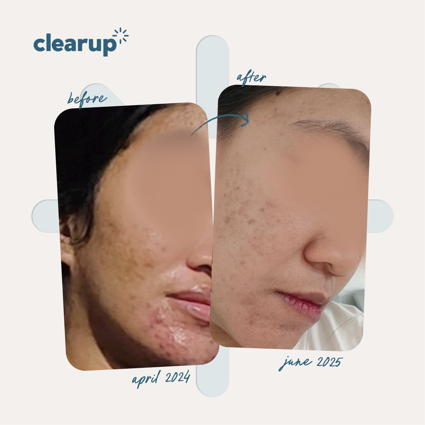 CLEARUP Clearing Gel Micronized Benzoyl Peroxide 2.5% 60g