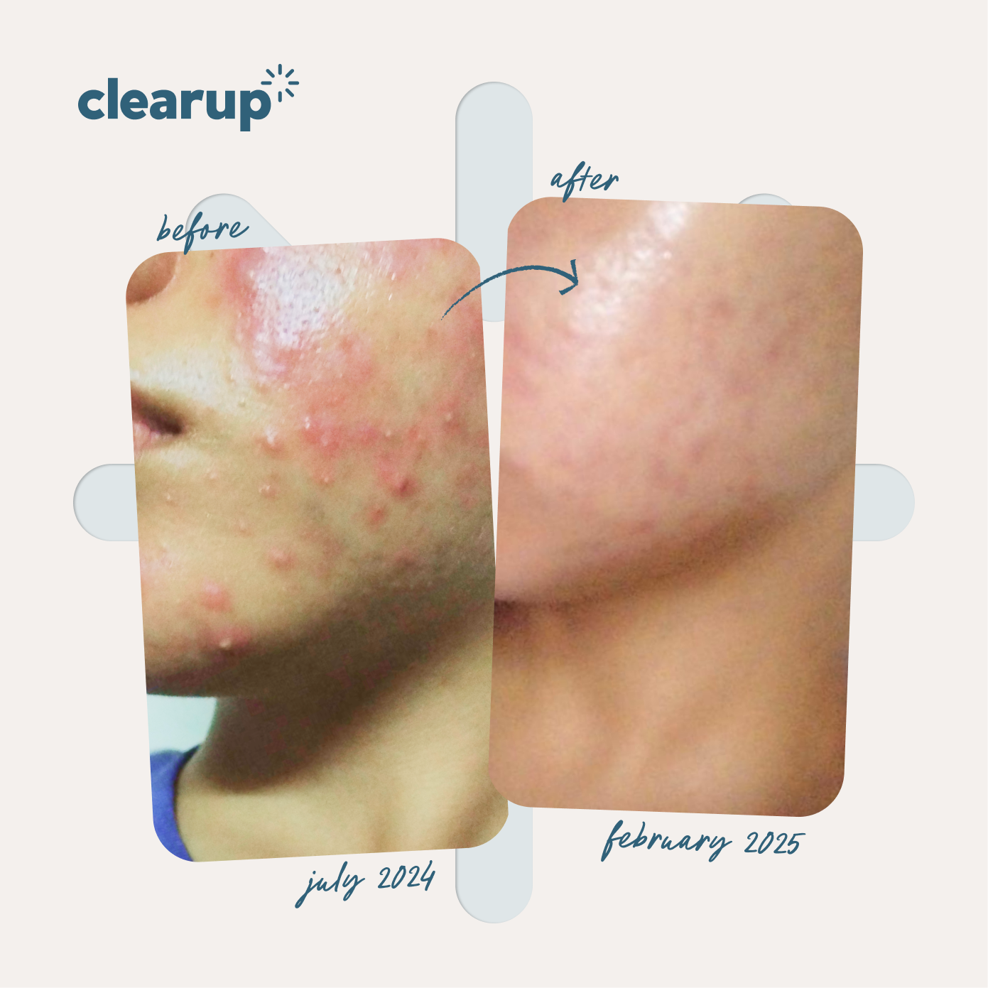 CLEARUP Clearing Gel Micronized Benzoyl Peroxide 2.5% 60g