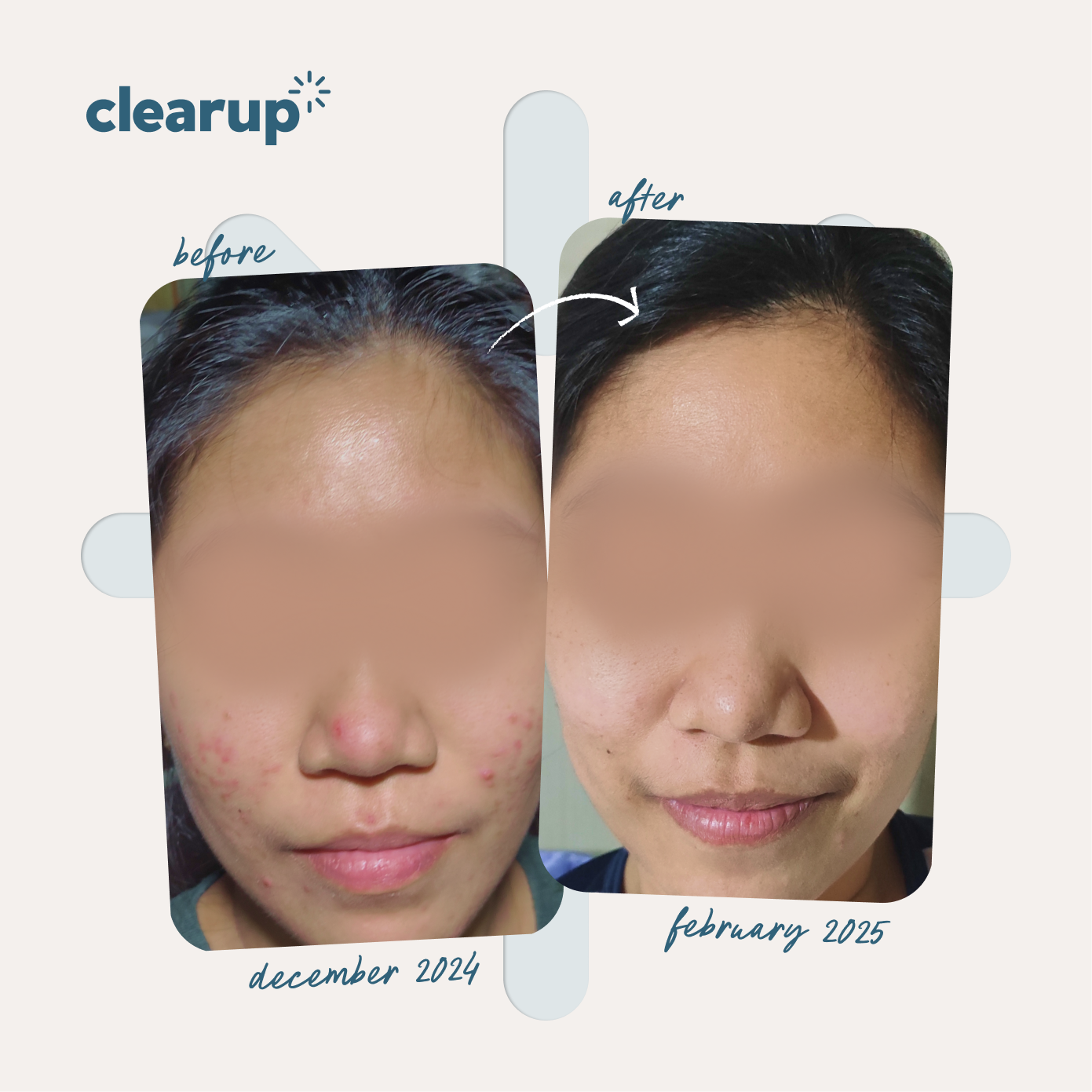 CLEARUP Clearing Gel Micronized Benzoyl Peroxide 2.5% 60g