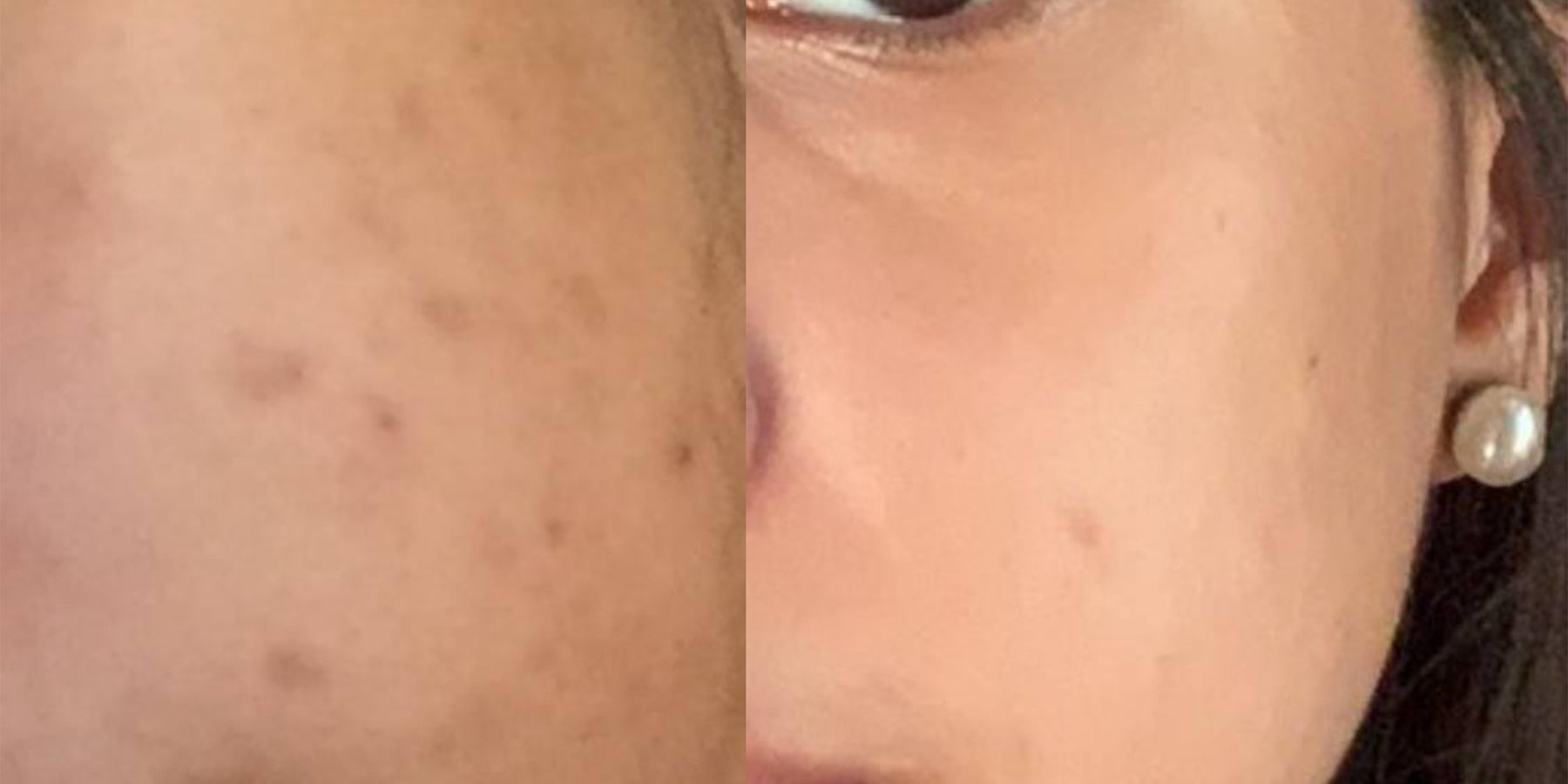 Before & After: Post Acne Marks