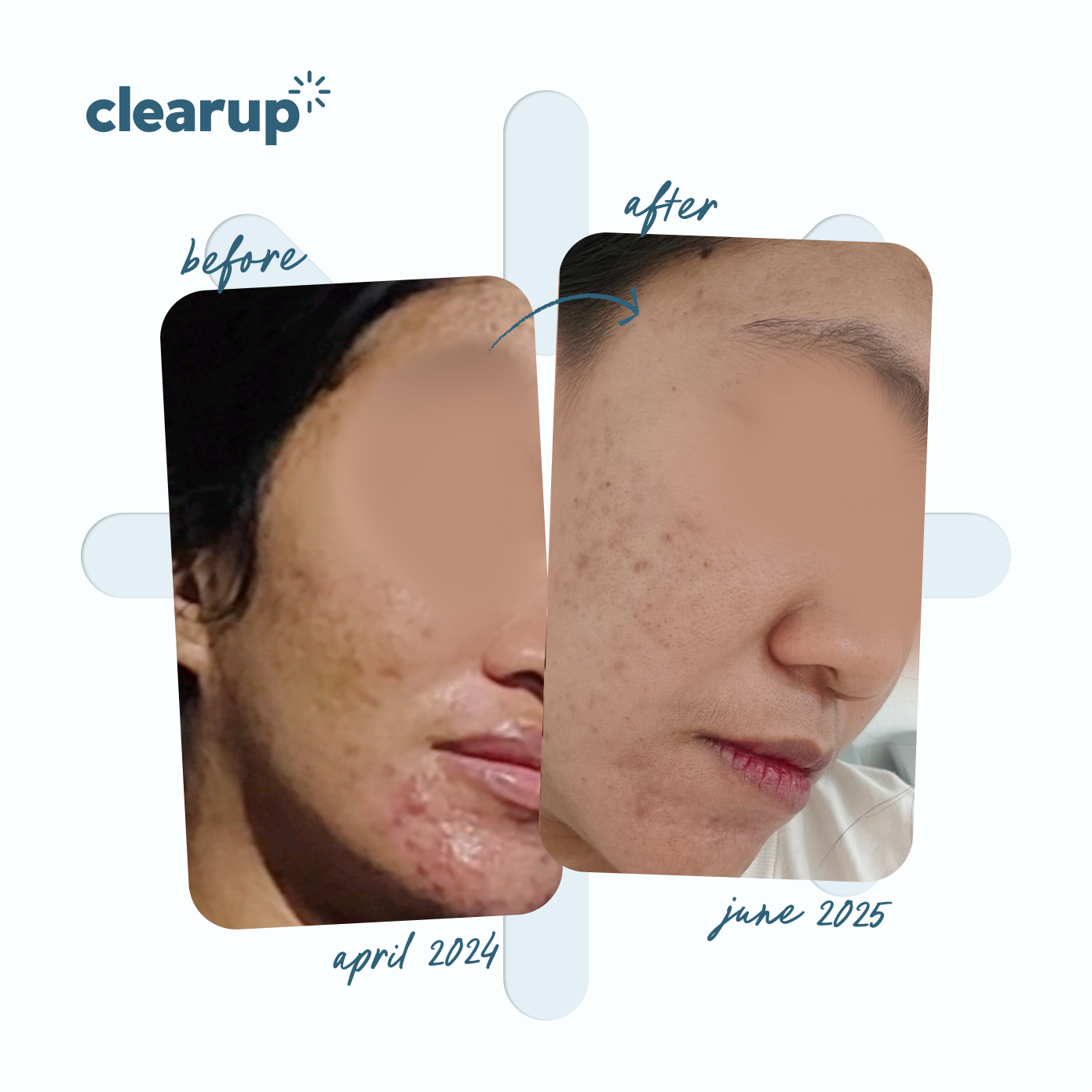 MICRONIZED BENZOYL PEROXIDE 2.5% 15g