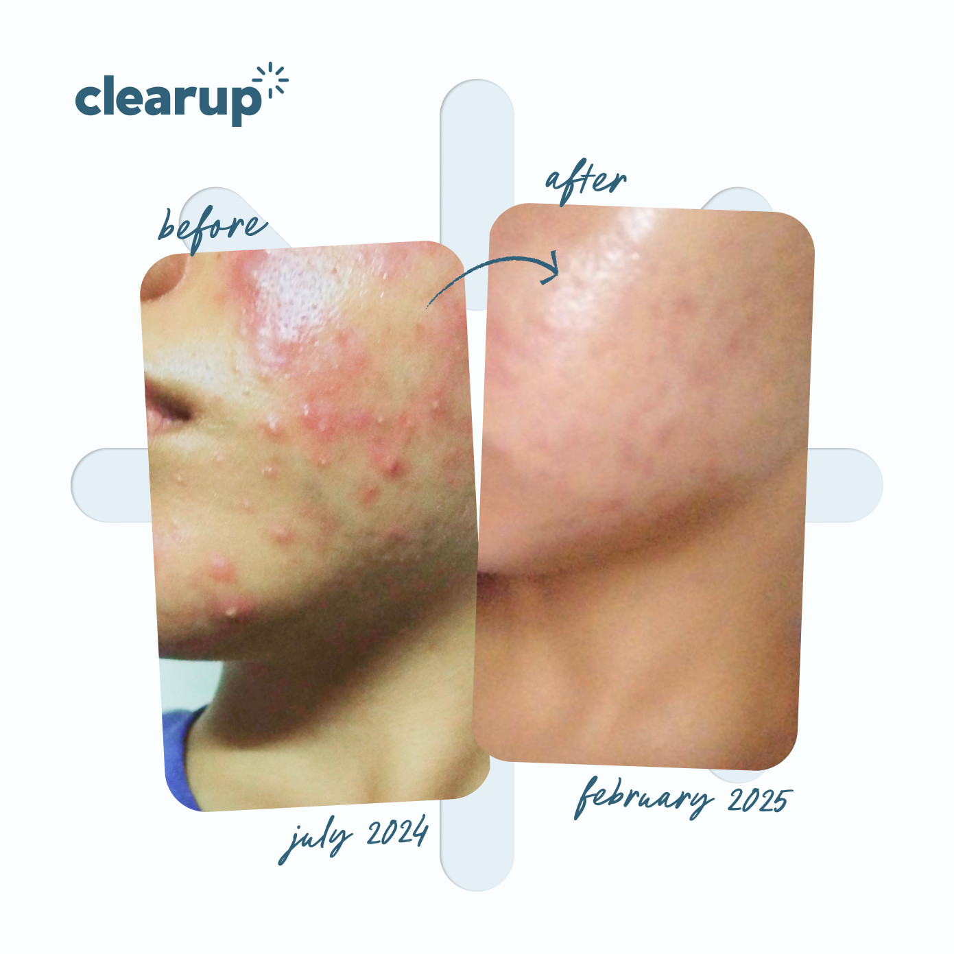 Micronized Benzoyl Peroxide 2.5% 15g - Bundle of 2