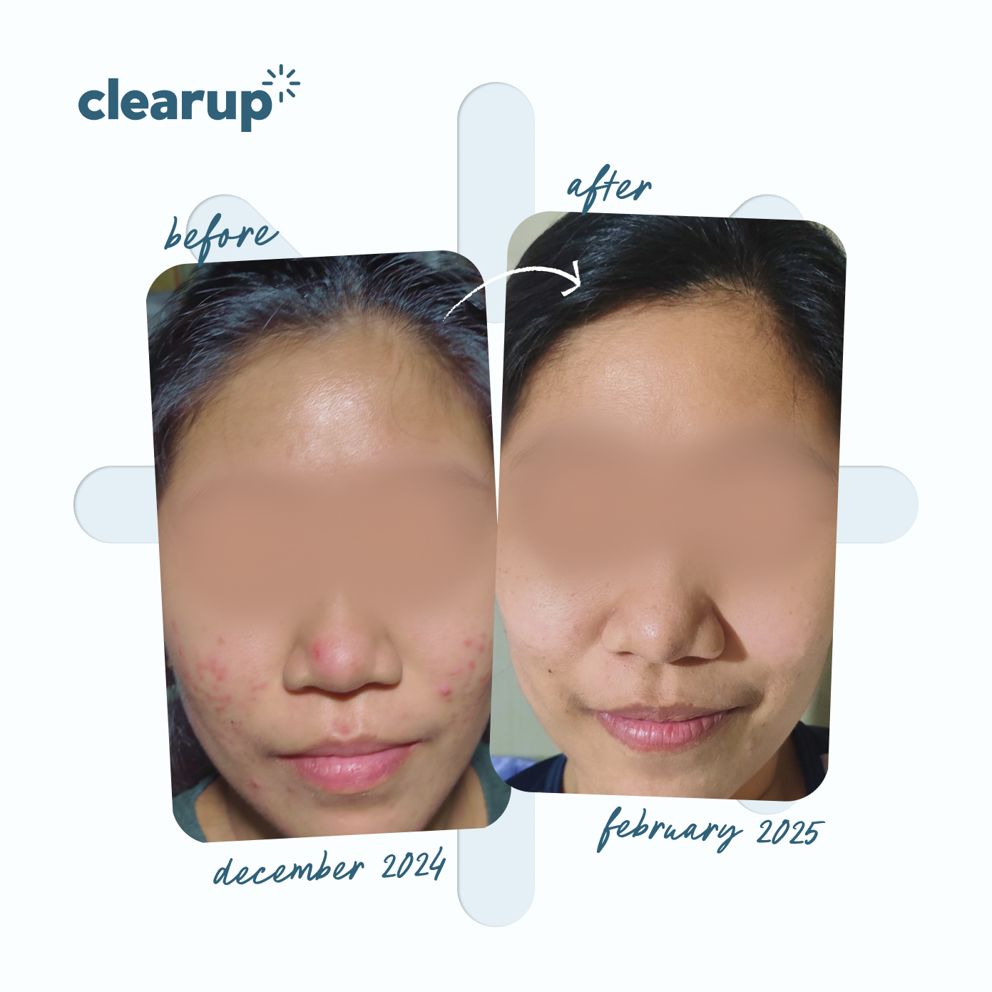 Micronized Benzoyl Peroxide 2.5% 15g - Bundle of 2